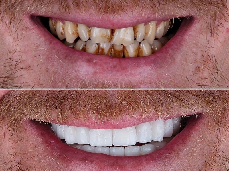 Types facettes dentaires : facettes en composite et en céramique