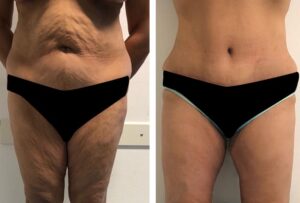 Abdominoplastie-Paris