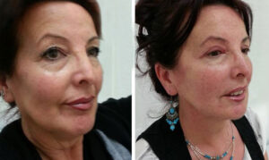 Lipofilling visage avant après