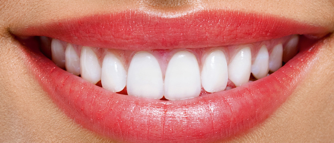 Facette dentaire pour un sourire esthétique blanc et uniforme