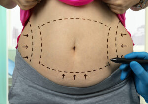 chirurgie-abdomen-paris