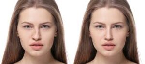 resultat-rhinoplastie