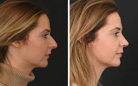 rhinoplastie conservatrice