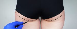 lifting-fesses