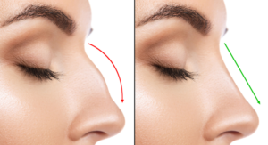 prix-rhinoplastie-Paris