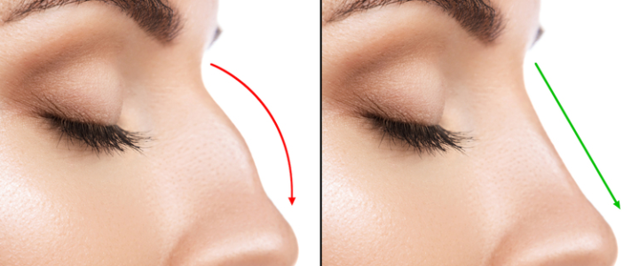 prix-rhinoplastie-Paris