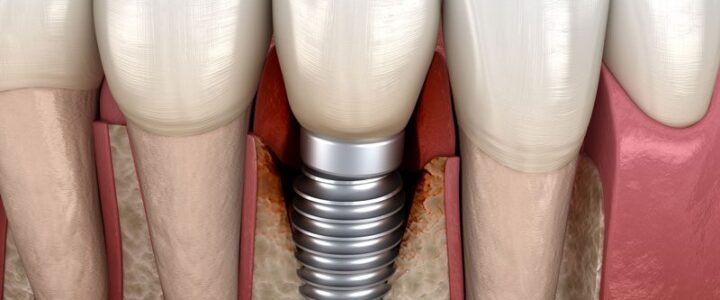 implant-dentaire-Paris