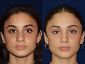 rhinoplastie-ethnique