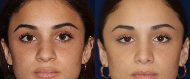 Tout savoir sur la rhinoplastie ethnique Tout savoir sur la rhinoplastie ethnique