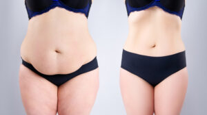 abdominoplastie