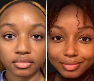 rhinoplastie-ethnique
