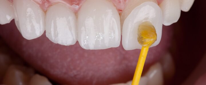 Facettes dentaires : le secret d’un sourire éclatant et harmonieux