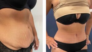 abdominoplastie