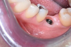 implants-dentaires-Paris