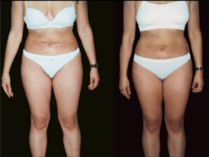 correction-liposuccion