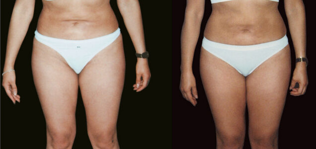 correction-liposuccion