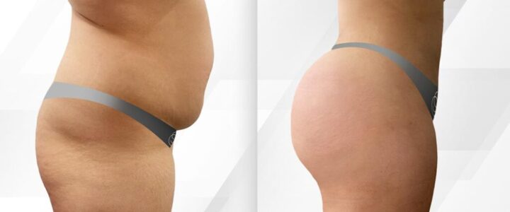 BBL ou implants fessiers